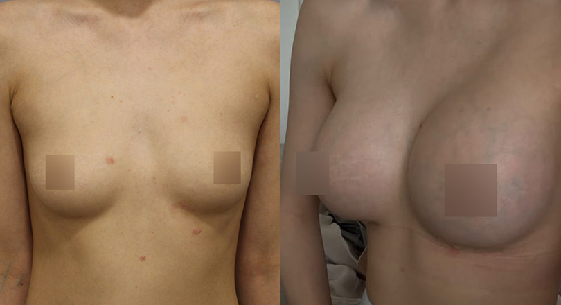 Ảnh trước & sau của Phẫu thuật ngực