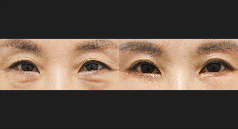 눈성형 전후사진 (하안검, 외안각고정)