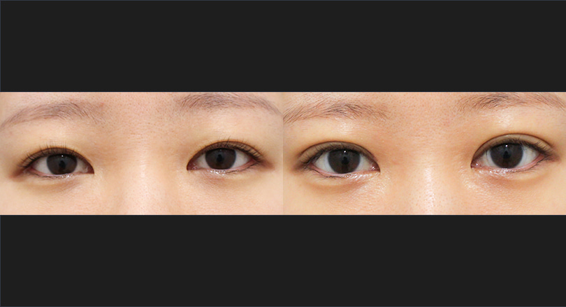 눈성형 전후사진 (자연유착, 윗트임)