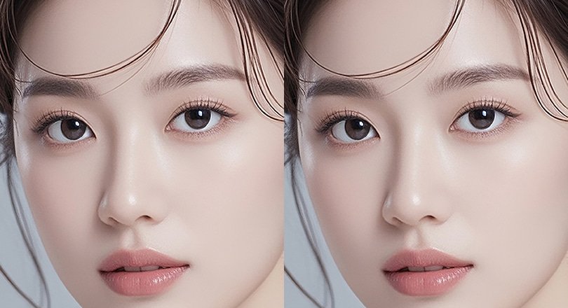 Ảnh trước & sau của Cấy mỡ tự thân