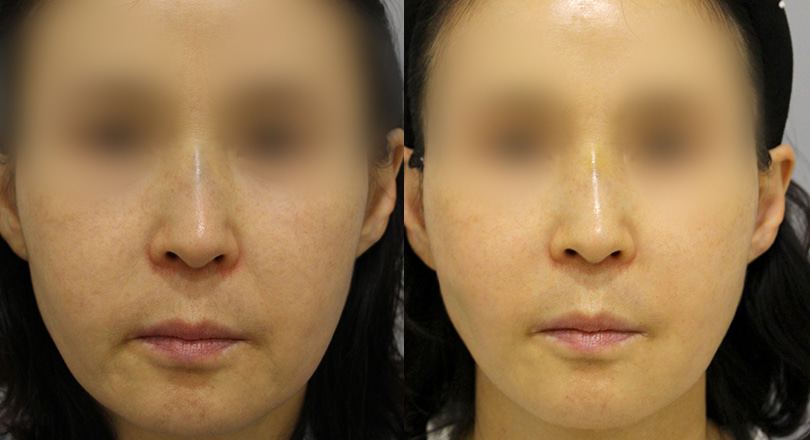Ảnh trước & sau của Nâng cơ mặt