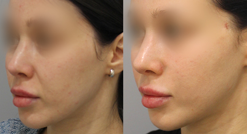 Ảnh trước & sau của Nâng cơ mặt