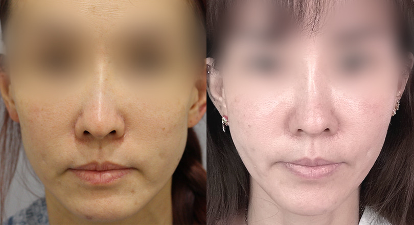 Ảnh trước & sau của Nâng cơ mặt