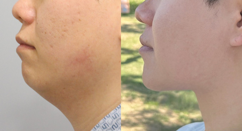 Ảnh trước & sau của Hút mỡ