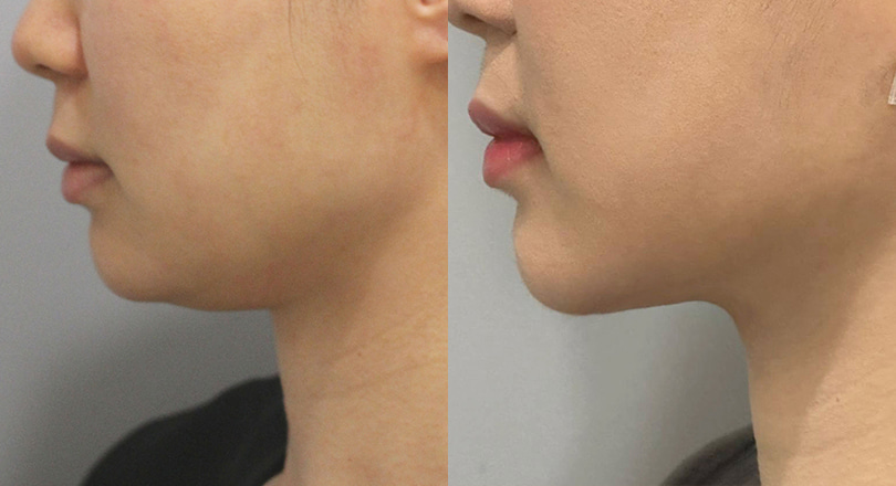 Ảnh trước & sau của Hút mỡ
