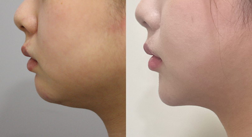Ảnh trước & sau của Hút mỡ