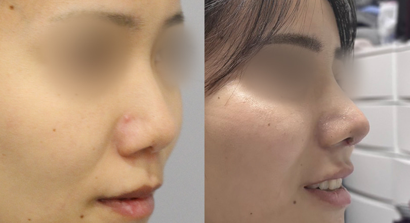 Ảnh trước & sau của Phẫu thuật mũi (Phẫu thuật mũi, chỉnh mũi ngắn, chỉnh góc mũi môi)