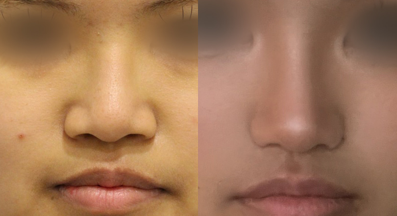 Ảnh trước & sau của Phẫu thuật mũi (Thu gọn cánh mũi (phương pháp cắt))