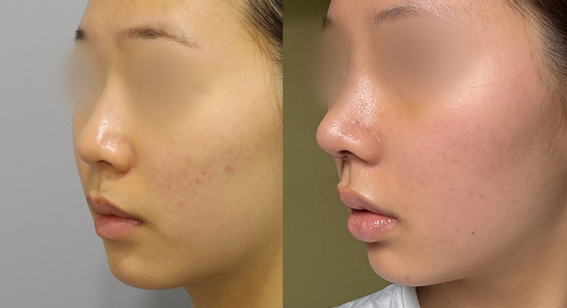 Ảnh trước & sau của Phẫu thuật mũi (Phẫu thuật mũi)